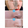 Набор для удаления черных точек Medi-Peel Extra Super 9+Cotton Pad