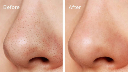 Патчи от черных точек Dr Althea Pro Lab Blackhead Zero 2 Step Nose Patch