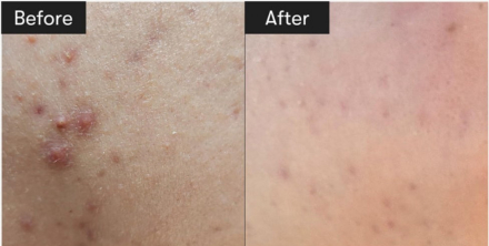 Саше с микроиглами VT Cosmetics Reedle Shot 300 Stick Pouch